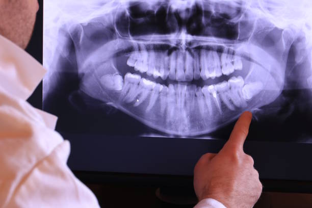 Best Emergency Dentist for Lost Fillings or Crowns in Bunk Foss, WA